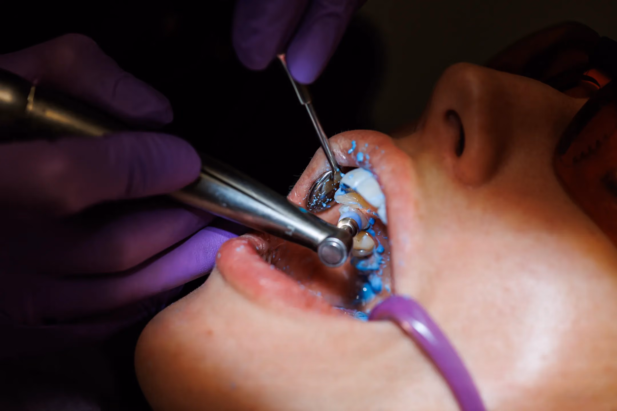 Fluoride Treatment